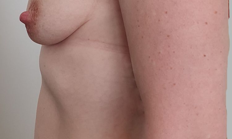 Bruststrafung nach Kindern mit Implantat möglich? - 75252