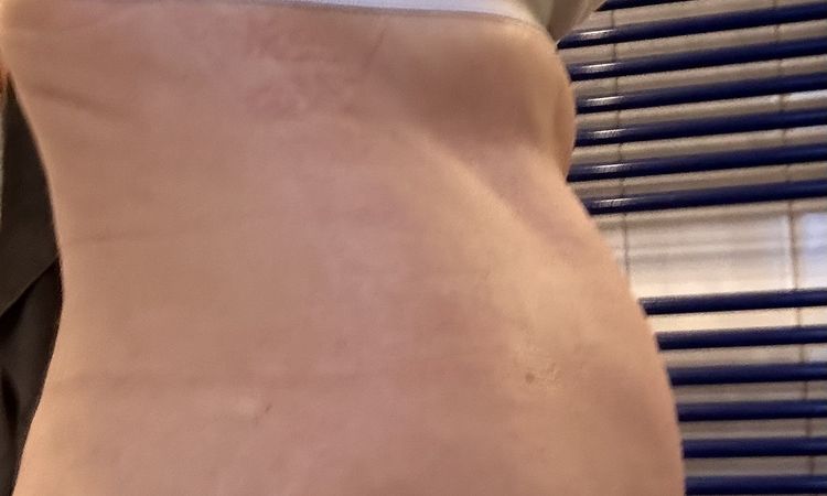 Schwellung nach 10 Wochen so normal? - 75290