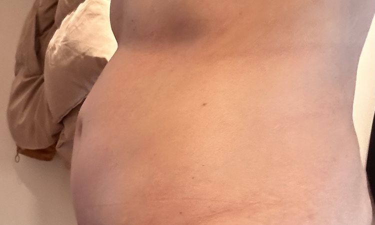Schwellung nach 10 Wochen so normal? - 75292