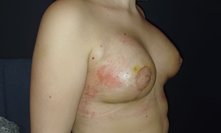 Bruststraffung tubuläre Brust, 4 Wochen post OP - 75315