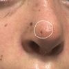 Warum wurde ich auf der Nasenspitze genäht bei Nasenkorrektur Rhinoplastik ?