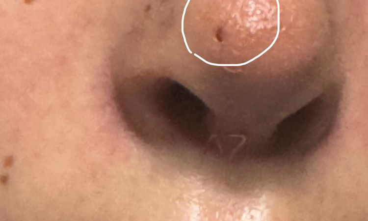 Warum wurde ich auf der Nasenspitze genäht bei Nasenkorrektur Rhinoplastik ? - 75346