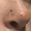 Warum wurde ich auf der Nasenspitze genäht bei Nasenkorrektur Rhinoplastik ?