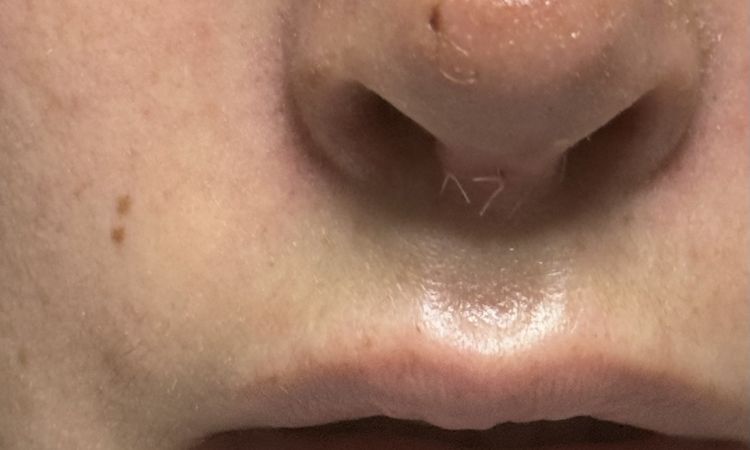 Warum wurde ich auf der Nasenspitze genäht bei Nasenkorrektur Rhinoplastik ? - 75350