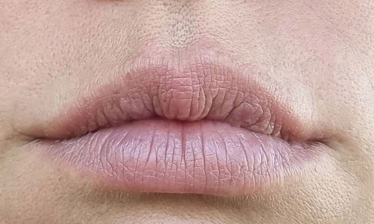 Lippenvergrößerung mit Eigenfett, schiefgegangen - 75419