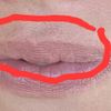 Lippenvergrößerung mit Eigenfett, schiefgegangen