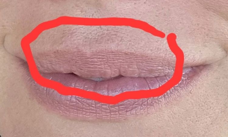 Lippenvergrößerung mit Eigenfett, schiefgegangen - 75420