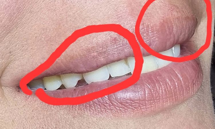 Lippenvergrößerung mit Eigenfett, schiefgegangen - 75421