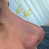 6 Monate Post Nasenkorrektur