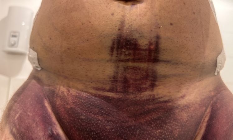 Liposuction Komplikationen - 75659