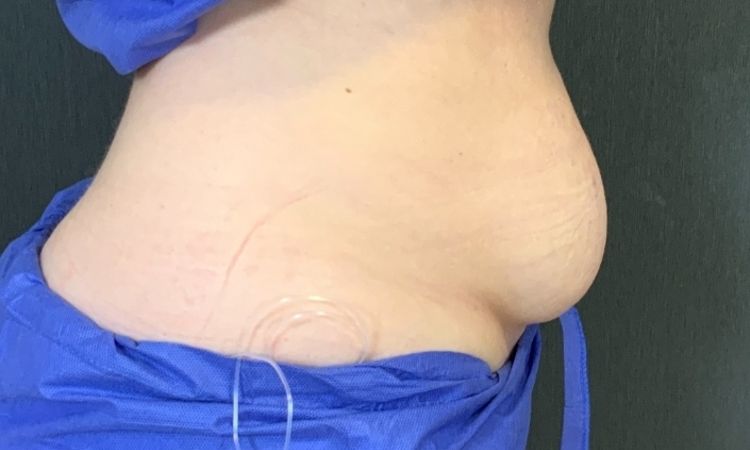 Unzufrieden nach Liposuktion am Bauch - 75754