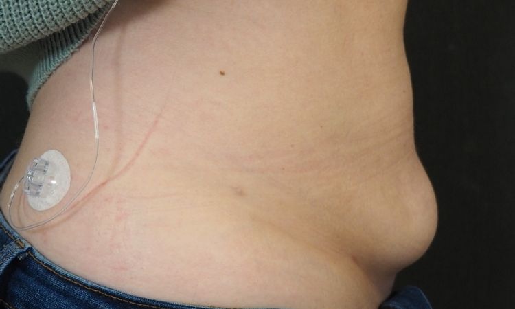 Unzufrieden nach Liposuktion am Bauch - 75755