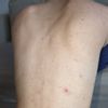 Welche Behandlung könnte mir mit Narben und Hyperpigmentierungen helfen?