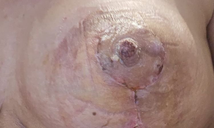 6 Tage nach bruststraffung mit Implantatwechsel Loch in brust - 76000