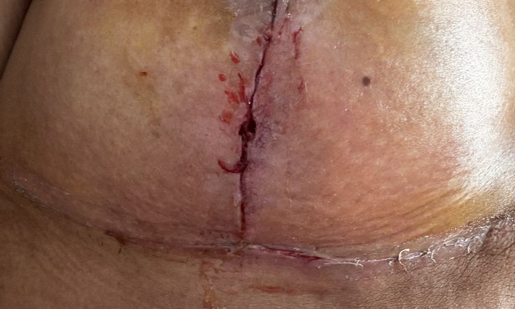 6 Tage nach bruststraffung mit Implantatwechsel Loch in brust - 76001