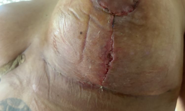 6 Tage nach bruststraffung mit Implantatwechsel Loch in brust - 76003