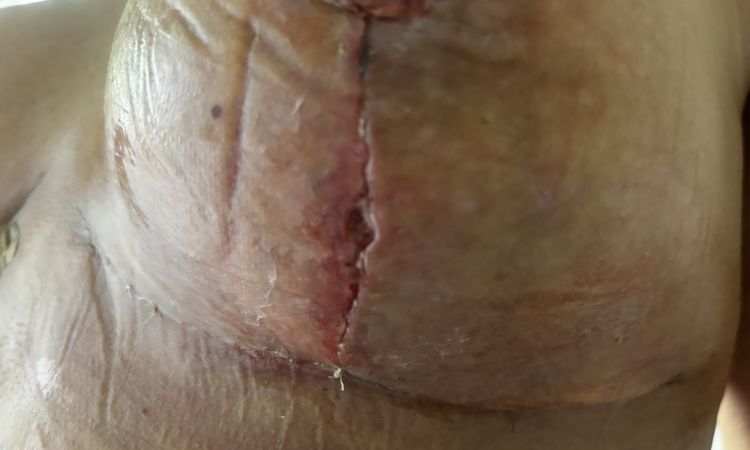 6 Tage nach bruststraffung mit Implantatwechsel Loch in brust - 76004
