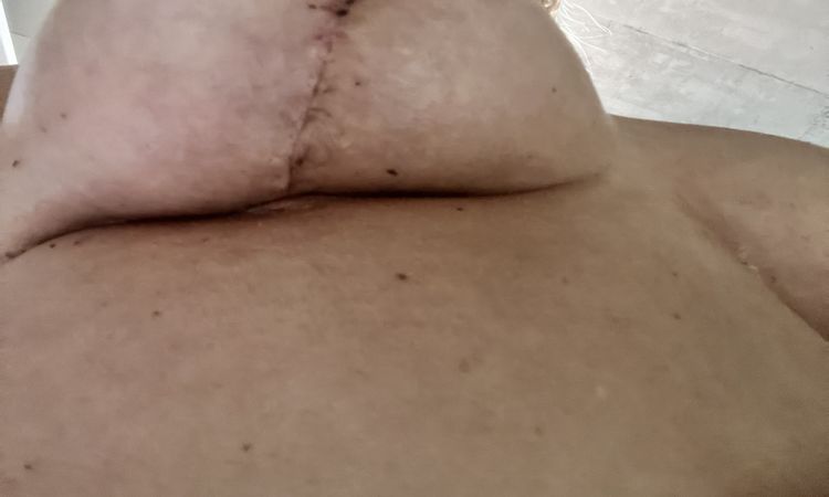 Asymmetrie Bruststraffung - 76070