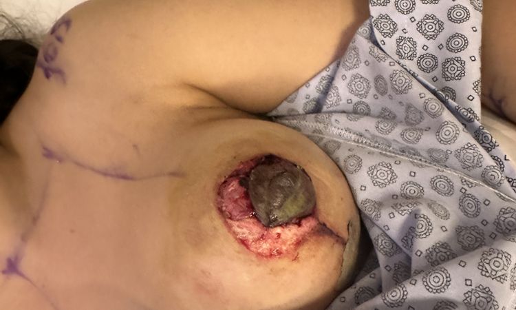Bruststraffung mit Komplikation - 76239