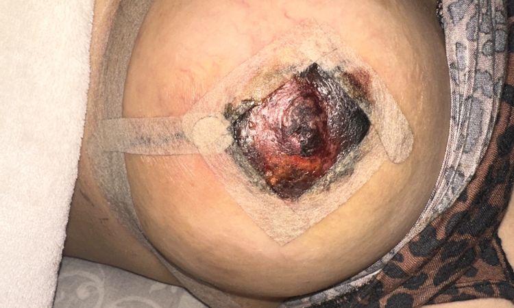 Bruststraffung mit Komplikation - 76242