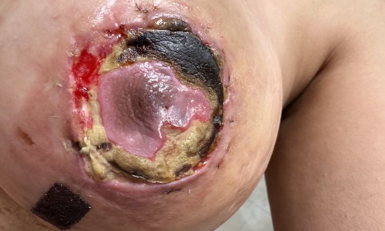 Bruststraffung mit Komplikation - 76243