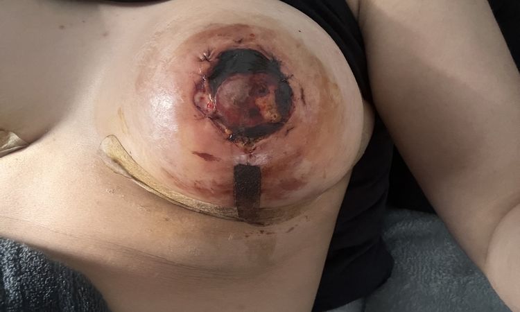 Bruststraffung mit Komplikation - 76245