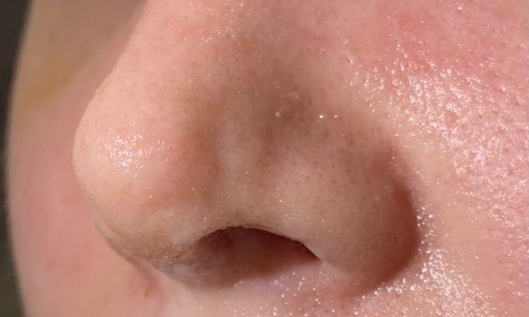 Korrektur? Delle linke Seite der Nasenspitze 3 Wochen nach Rhinoplastik - 76362