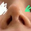 Korrektur? Delle linke Seite der Nasenspitze 3 Wochen nach Rhinoplastik