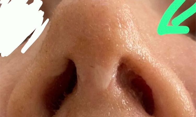 Korrektur? Delle linke Seite der Nasenspitze 3 Wochen nach Rhinoplastik - 76363