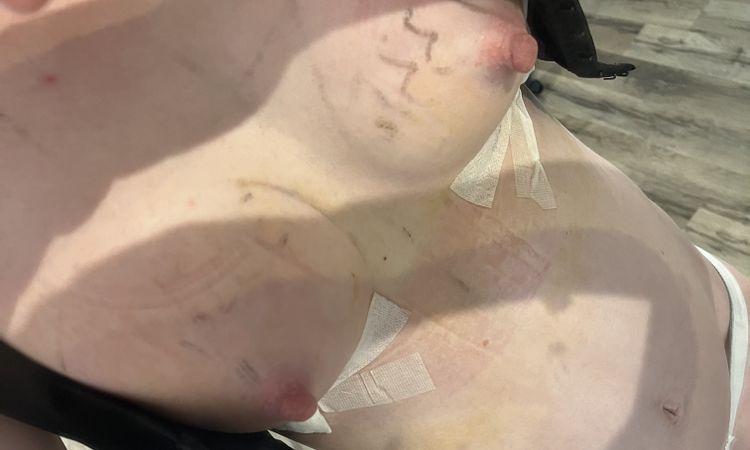 Sieht die Brust nach 3 Tagen normal aus? - 76373