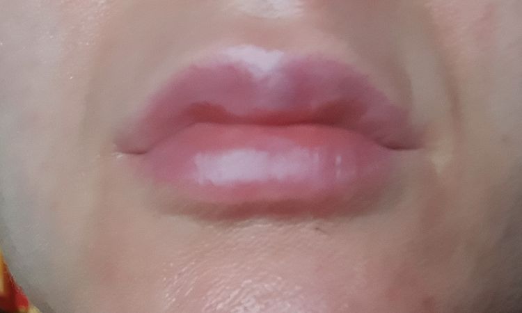 Probleme nach Lippen aufspritzen - 76445