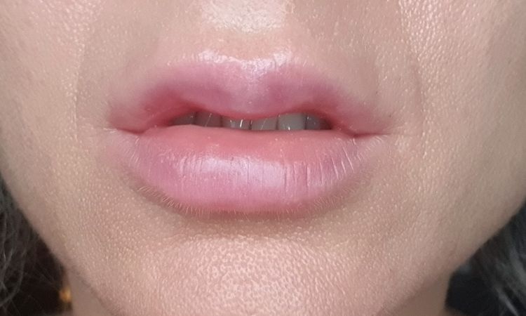 Probleme nach Lippen aufspritzen - 76446