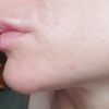 Probleme nach Lippen aufspritzen