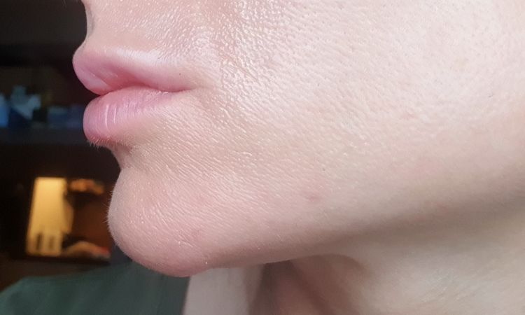 Probleme nach Lippen aufspritzen - 76447