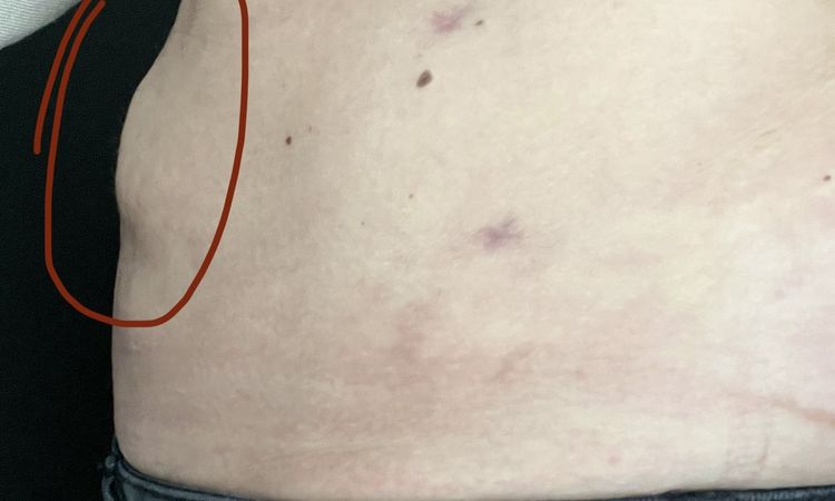 Fettige Spritze nach Liposuktion - 76500