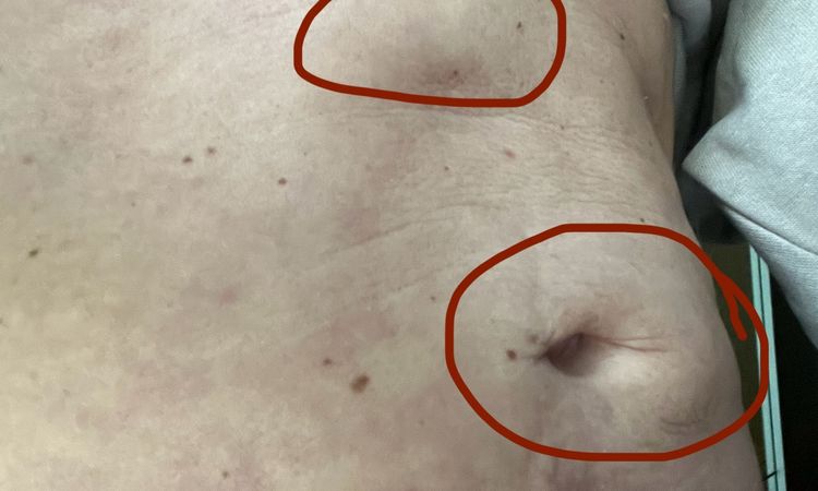 Fettige Spritze nach Liposuktion - 76502