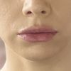 Lip Flip mit botox oder bullhorn Lift