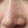 Korrektur Dellen- zu schmale Nasenspitze nach Rhinoplastik