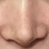 Korrektur Dellen- zu schmale Nasenspitze nach Rhinoplastik