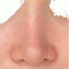 Korrektur Dellen- zu schmale Nasenspitze nach Rhinoplastik