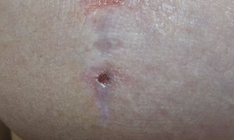 Brust Op Implantwechsel - 76673