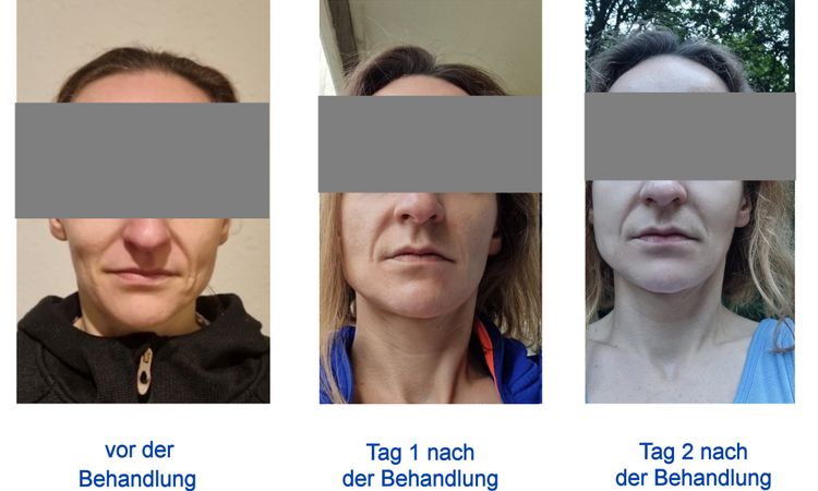 Hyaluronsäure Unterspritzung hilft nicht - 76699