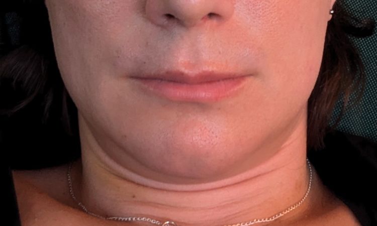 Hyaluron statt Liplift möglich bei mir? - 76944