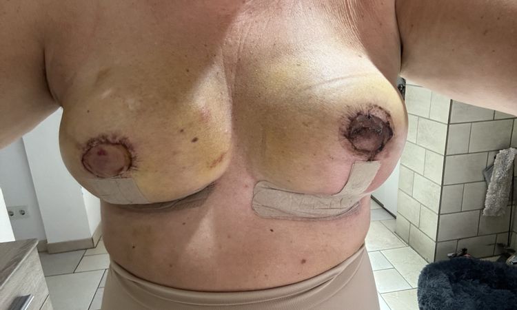 Mastopexie - Lipofilling - Asymmetrie - 76973