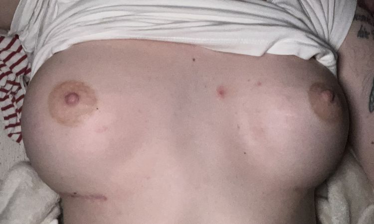 Warum steht eine Brust steif und hart im Liegen hoch und die andere nicht ? - 76987