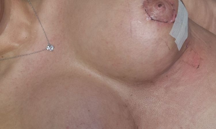Implantat sitzt hoch und unten nur halb ausgefüllt motiva - 77017