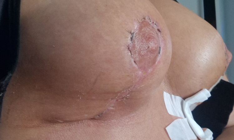 Implantat sitzt hoch und unten nur halb ausgefüllt motiva - 77018