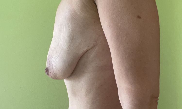 Bruststraffung und Implantate Korrektur - 77040