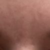 Nach Botox Behandlung welche Schritte weiter?