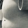 Komische Bauchform nach Bauchdeckenstraffung